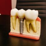Riesgos de realizar un implante dental