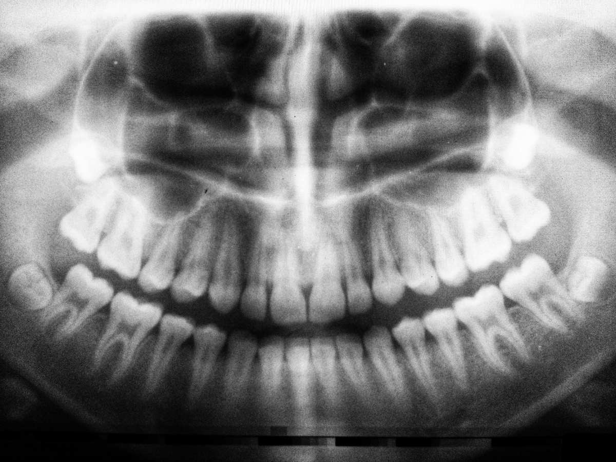 radiografía tridimensional dental en blanco y negro